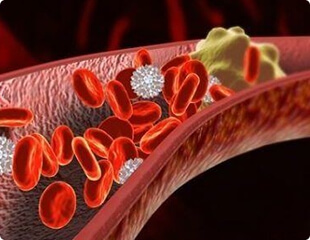 Coaguli di sangue che ostruiscono un'arteria - causa di infarto